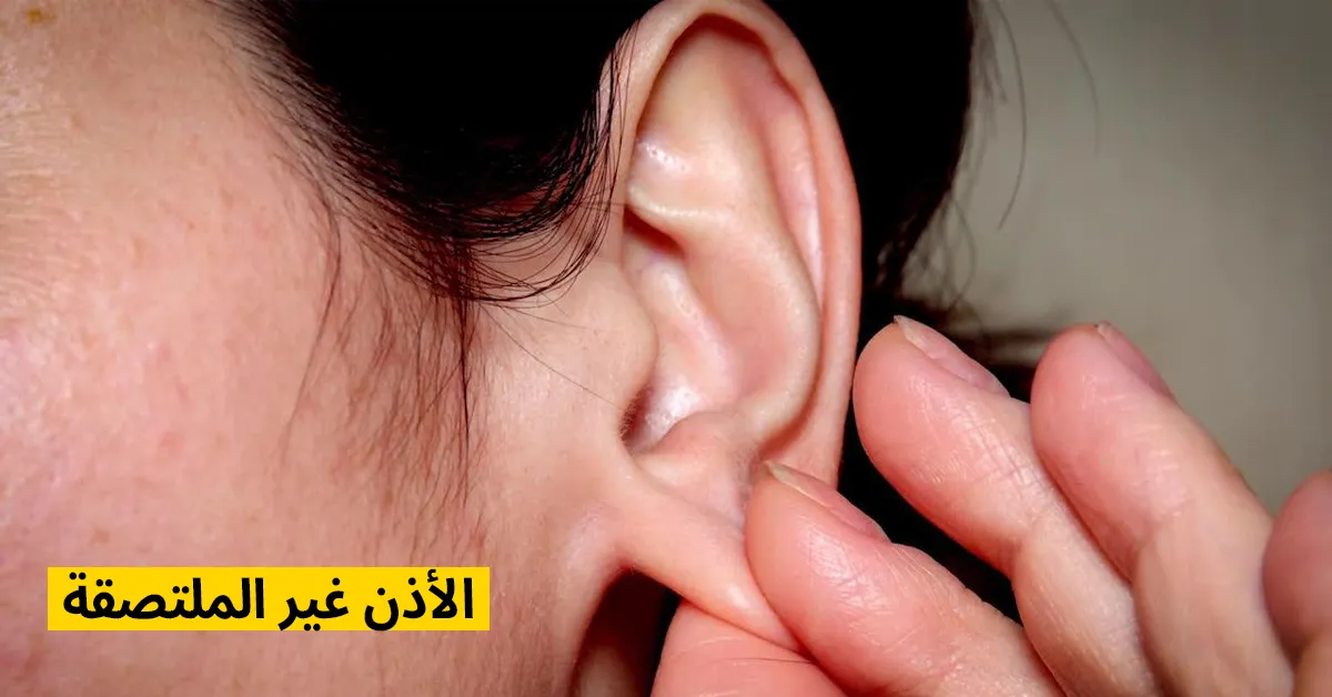 الأذن غير الملتصقة